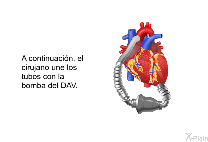 A continuaci�n, el cirujano une los tubos con la bomba del DAV.