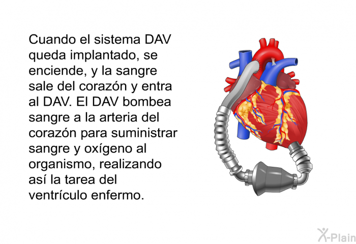 Cuando el sistema DAV queda implantado, se enciende, y la sangre sale del coraz�n y entra al DAV.&nbsp;El DAV bombea sangre a la arteria del coraz�n para suministrar sangre y ox�geno al organismo, realizando as� la tarea del ventr�culo enfermo.