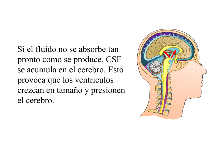 Si el fluido no se absorbe tan pronto como se produce, CSF se acumula en el cerebro. Esto provoca que los ventrculos crezcan en tamao y presionen el cerebro.