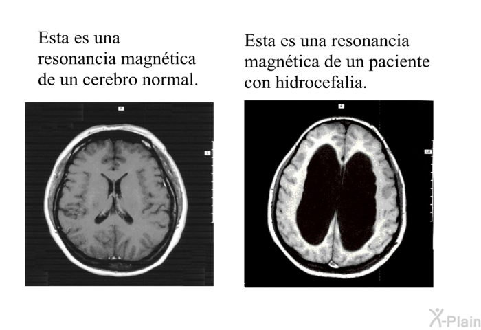 Esta es una resonancia magntica de un cerebro normal. Esta es una resonancia magntica de un paciente con hidrocefalia.