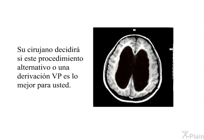 Su cirujano decidir� si este procedimiento alternativo o una derivaci�n VP es lo mejor para usted.