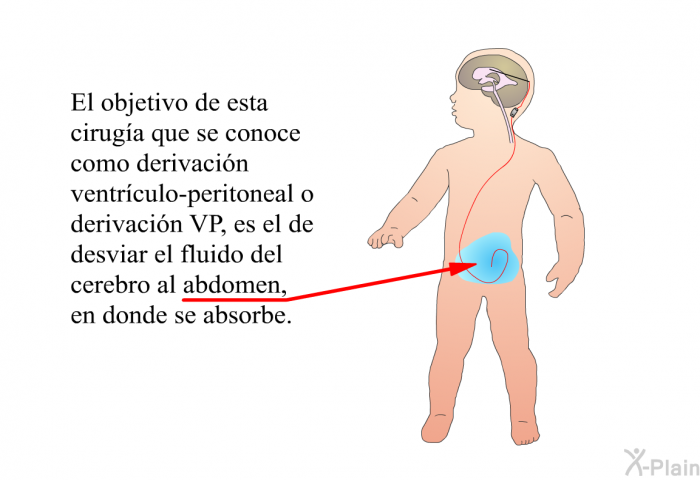 El objetivo de esta cirug�a que se conoce como derivaci�n ventr�culo-peritoneal o derivaci�n VP, es el de desviar el fluido del cerebro al abdomen, en donde se absorbe.