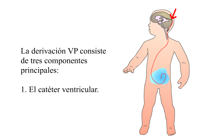 La derivacin VP consiste de tres componentes principales:  El catter ventricular.