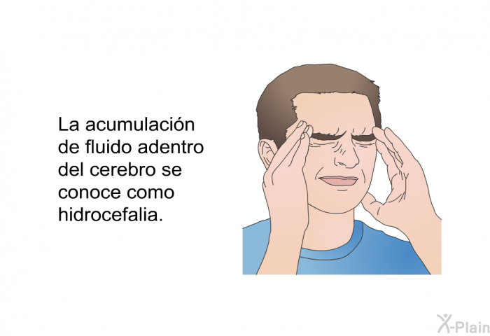 La acumulacin de fluido adentro del cerebro se conoce como hidrocefalia.