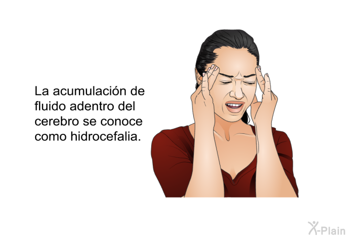 La acumulacin de fluido adentro del cerebro se conoce como hidrocefalia.