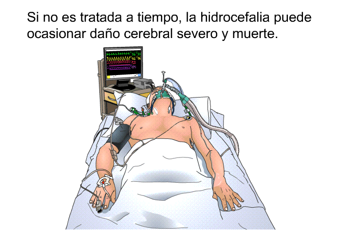 Si no es tratada a tiempo, la hidrocefalia puede ocasionar dao cerebral severo y muerte.