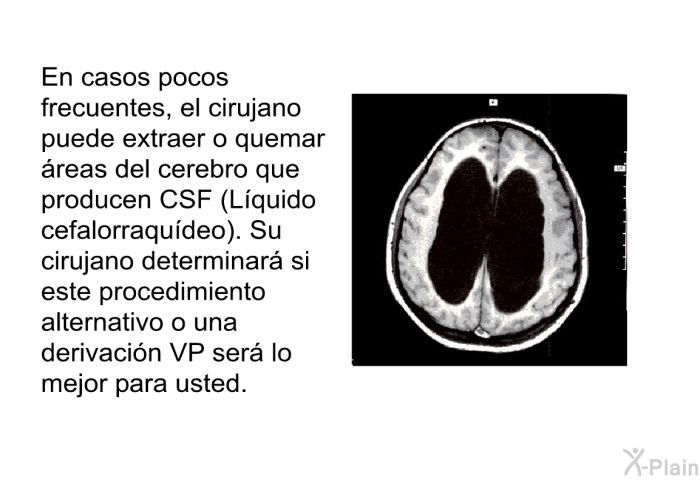 En casos pocos frecuentes, el cirujano puede extraer o quemar reas del cerebro que producen CSF (Lquido cefalorraqudeo). Su cirujano determinar si este procedimiento alternativo o una derivacin VP ser lo mejor para usted.