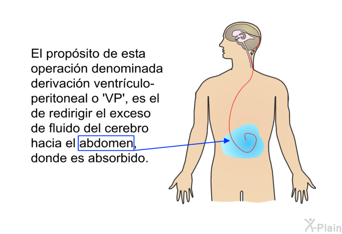 El propsito de esta operacin denominada derivacin ventrculo-peritoneal o  VP', es el de redirigir el exceso de fluido del cerebro hacia el abdomen, donde es absorbido.
