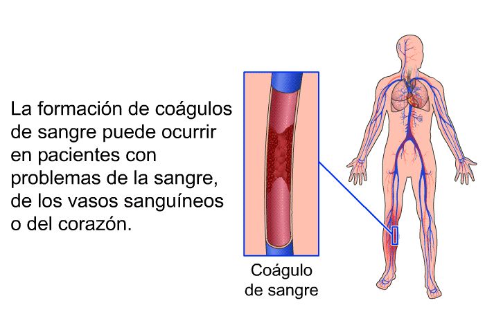 La formacin de cogulos de sangre puede ocurrir en pacientes con problemas de la sangre, de los vasos sanguneos o del corazn.