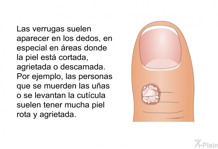Las verrugas suelen aparecer en los dedos, en especial en reas donde la piel est cortada, agrietada o descamada. Por ejemplo, las personas que se muerden las uas o se levantan la cutcula suelen tener mucha piel rota y agrietada.