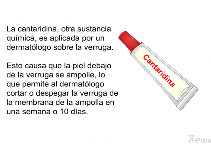 La cantaridina, otra sustancia qumica, es aplicada por un dermatlogo sobre la verruga. Esto causa que la piel debajo de la verruga se ampolle, lo que permite al dermatlogo cortar o despegar la verruga de la membrana de la ampolla en una semana o 10 das.