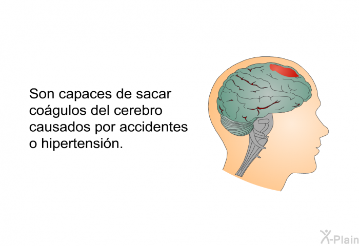 Son capaces de sacar cogulos del cerebro causados por accidentes o hipertensin.