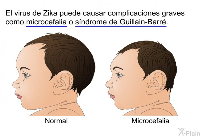 El virus de Zika puede causar complicaciones graves como microcefalia o sndrome de Guillain-Barr.